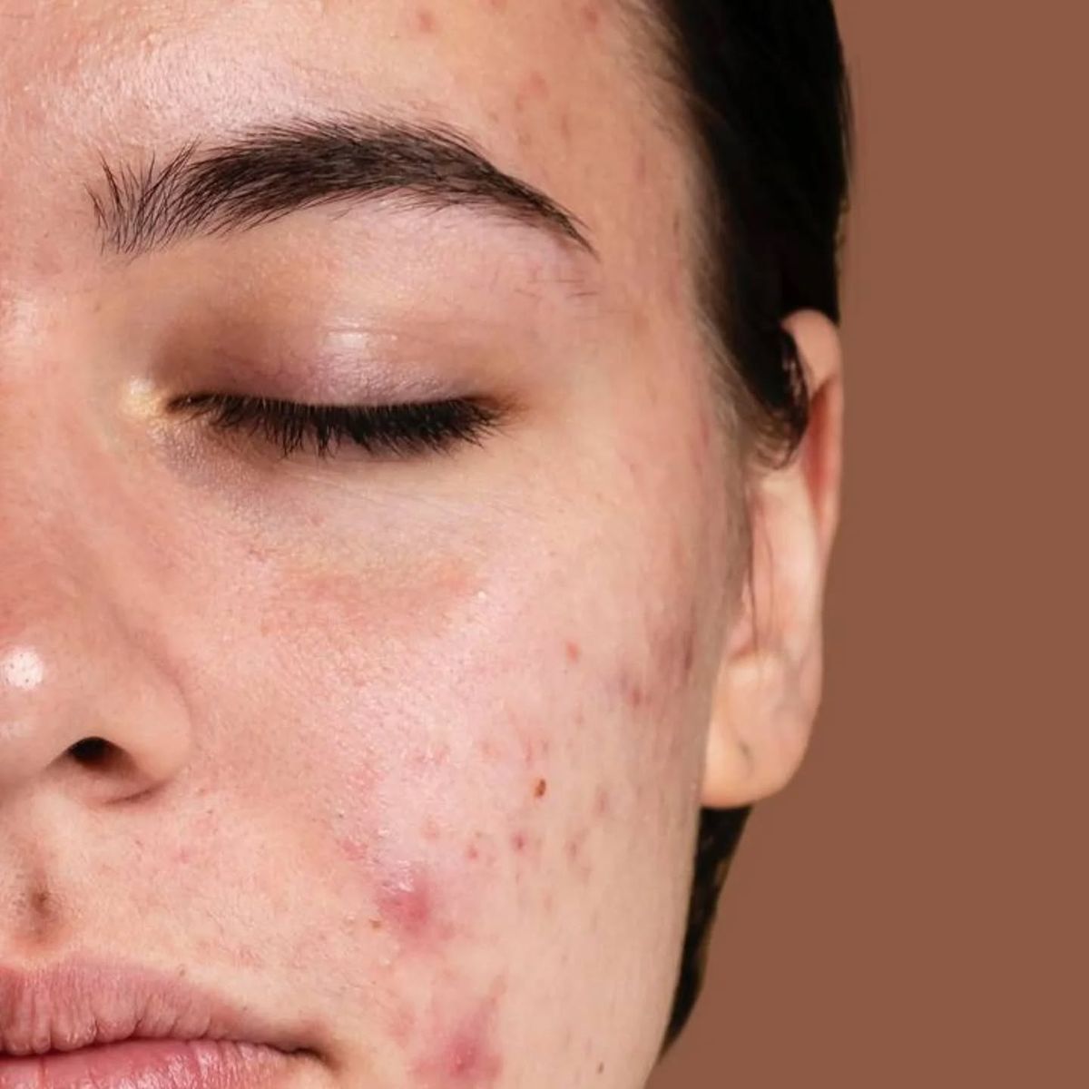 7 скрити причини за акне и как да се справиш с тях по естествен начин